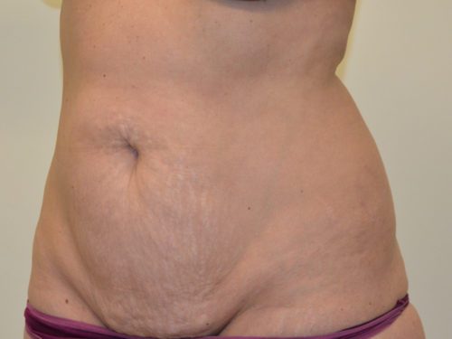 Tummy Tuck Before Patient 2