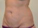 Tummy Tuck Before Patient Thumbnail 2