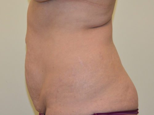 Tummy Tuck Before Patient 3