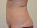 Tummy Tuck Before Patient Thumbnail 3