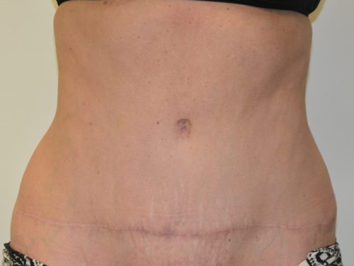 Tummy Tuck After Patient 1