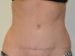 Tummy Tuck After Patient Thumbnail 1