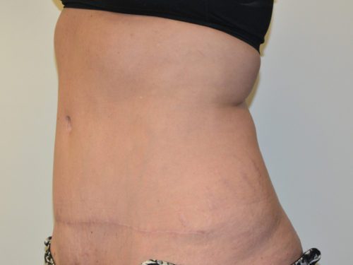 Tummy Tuck After Patient 2