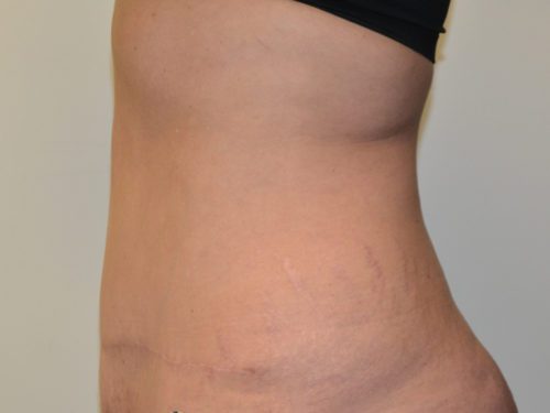 Tummy Tuck After Patient 3