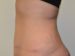 Tummy Tuck After Patient Thumbnail 3