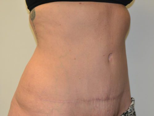 Tummy Tuck After Patient 4