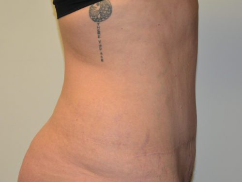 Tummy Tuck After Patient 5