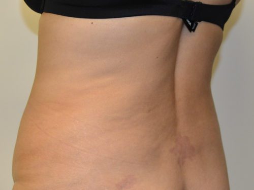 Liposuction Before Patient 2