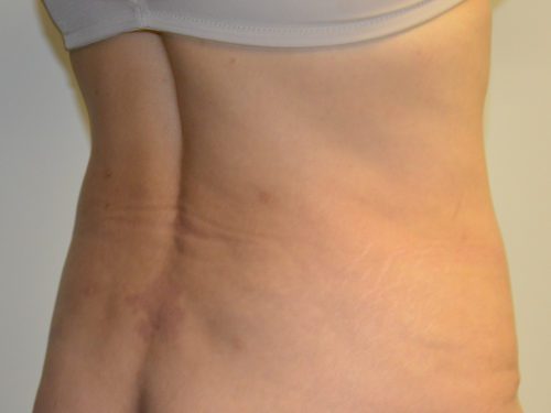 Liposuction After Patient 1