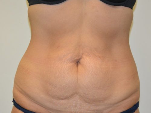 Tummy Tuck Before Patient 1