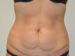 Tummy Tuck Before Patient Thumbnail 1