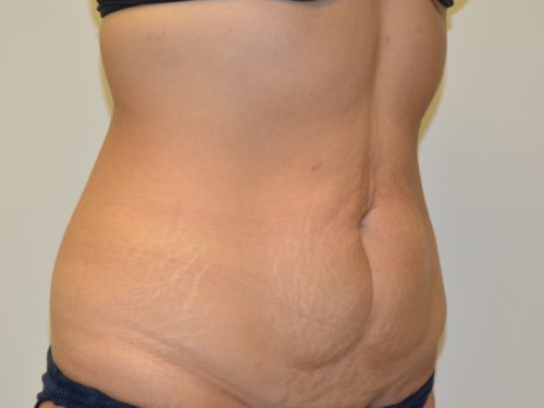 Tummy Tuck Before Patient 4