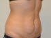 Tummy Tuck Before Patient Thumbnail 4