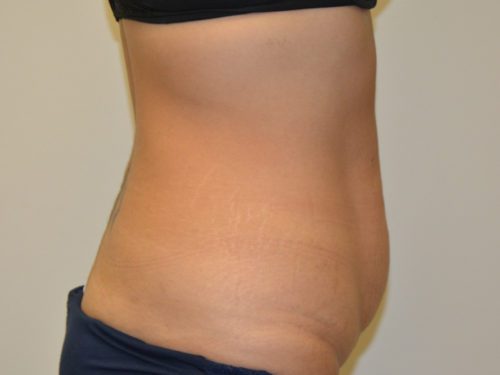 Tummy Tuck Before Patient 5