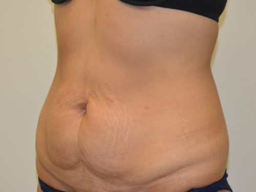 Tummy Tuck Before Patient 2