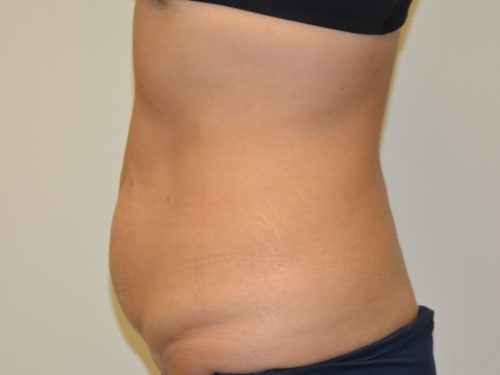 Tummy Tuck Before Patient 3