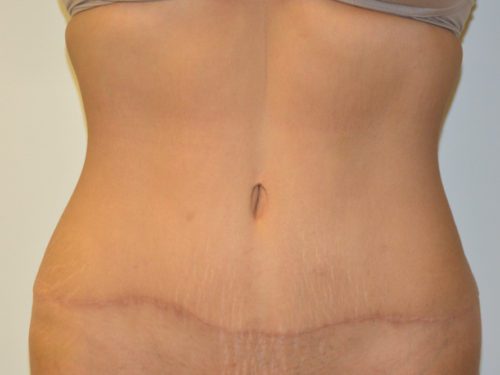 Tummy Tuck After Patient 1