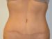 Tummy Tuck After Patient Thumbnail 1