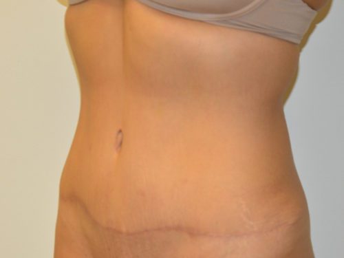 Tummy Tuck After Patient 2