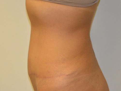 Tummy Tuck After Patient 3