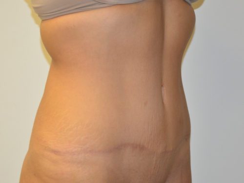 Tummy Tuck After Patient 4