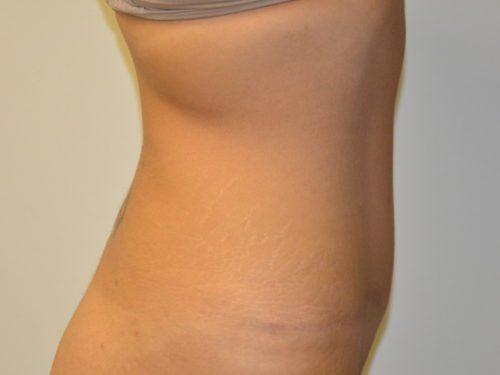 Tummy Tuck After Patient 5