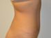 Tummy Tuck After Patient Thumbnail 5