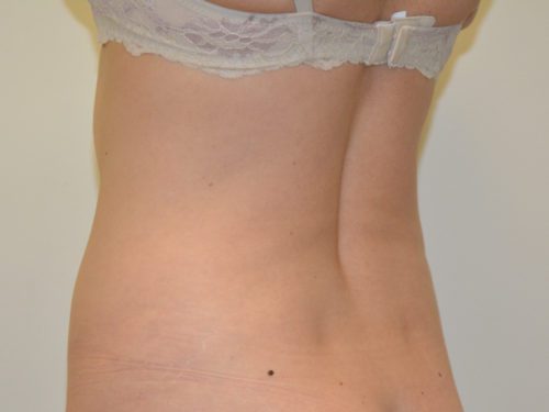 Liposuction Before Patient 1