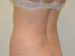 Liposuction Before Patient Thumbnail 1