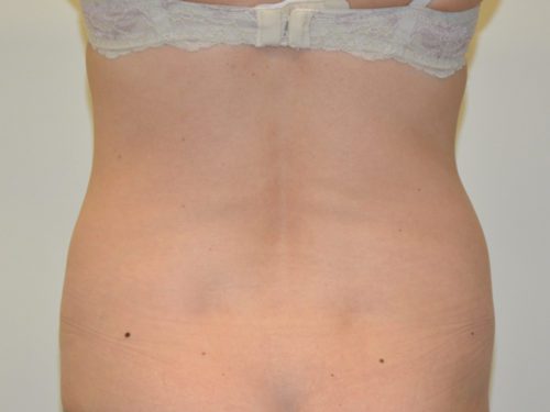 Liposuction Before Patient 2