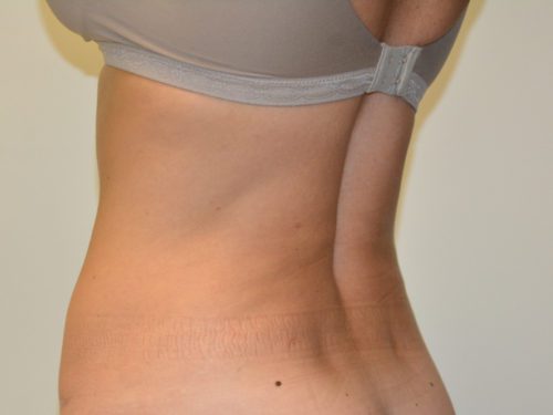 Liposuction After Patient 1