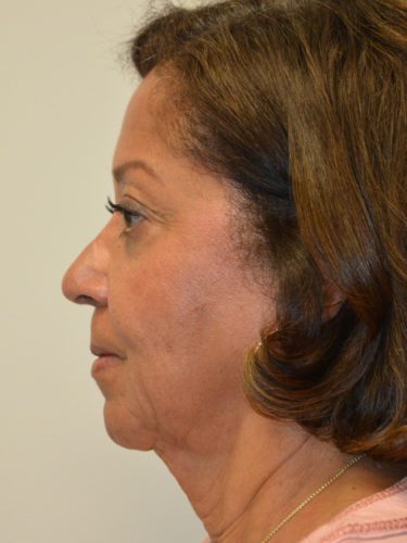 Facelift Before Patient 4