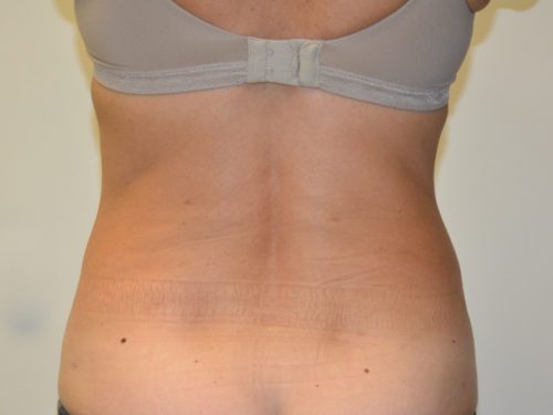 Liposuction After Patient 2