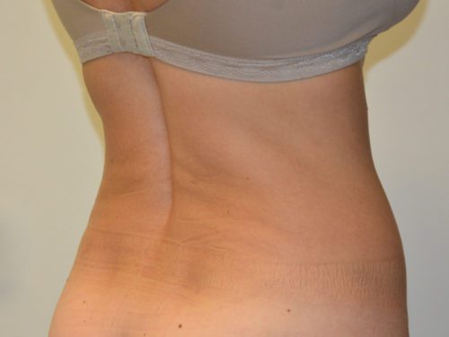 Liposuction After Patient 3