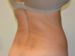 Liposuction After Patient Thumbnail 3