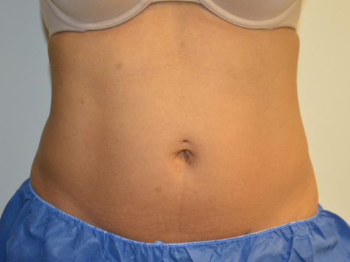Coolsculpting Before Patient 1