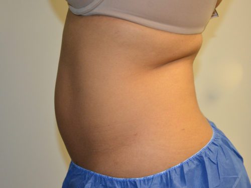 Coolsculpting Before Patient 5