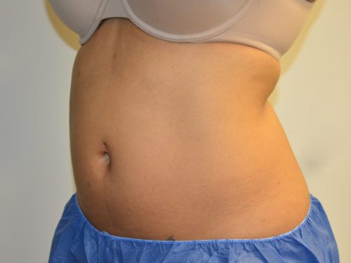 Coolsculpting Before Patient 4