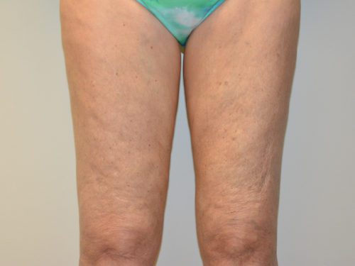 Coolsculpting After Patient 1