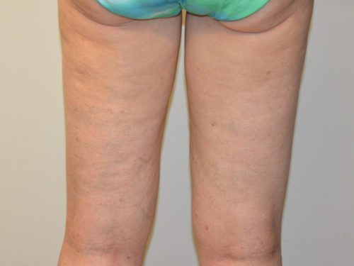 Coolsculpting After Patient 2