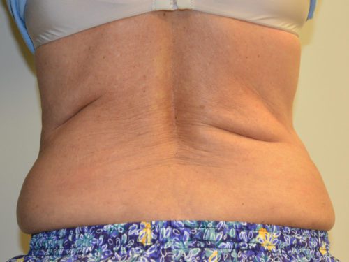 Coolsculpting Before Patient 1