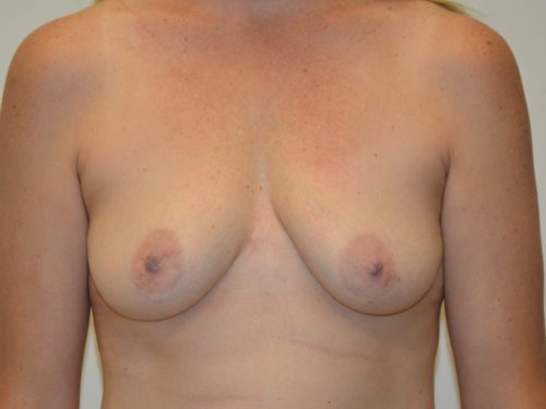 Breast Augmentation w/Lift Before Patient 1