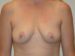 Breast Augmentation w/Lift Before Patient Thumbnail 1