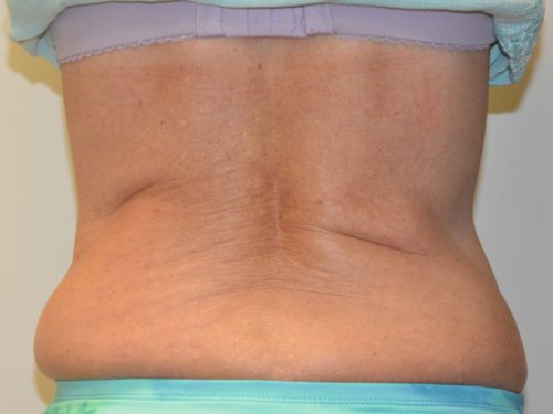 Coolsculpting After Patient 1