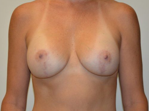 Breast Augmentation w/Lift After Patient 1