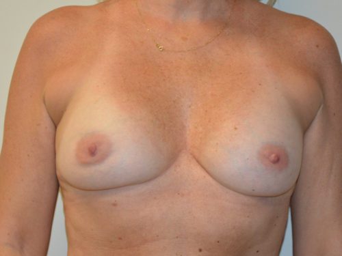 Breast Revision Before Patient 1