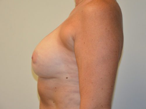 Breast Revision After Patient 3