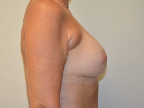 Breast Revision After Patient 5