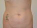 Tummy Tuck Before Patient Thumbnail 1