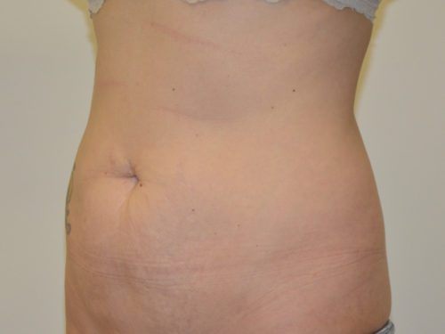 Tummy Tuck Before Patient 2